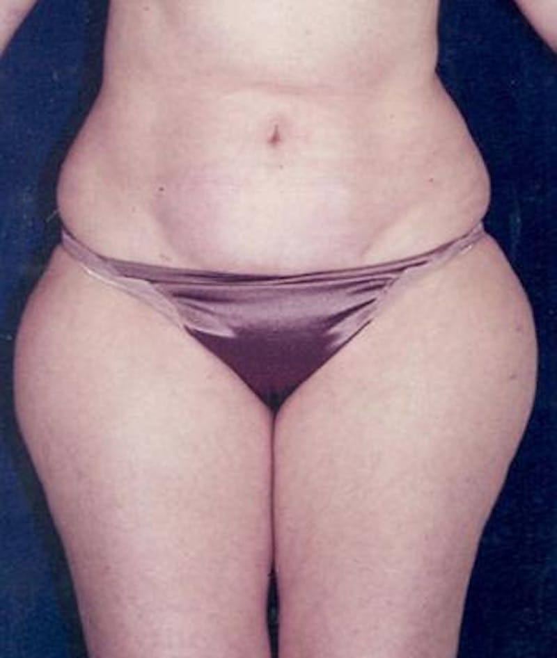Liposuction Before & After Gallery - Patient 108872 - Image 1
