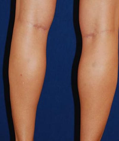 Calf Augmentation with Implants Before & After Gallery - Patient 825022 - Image 2