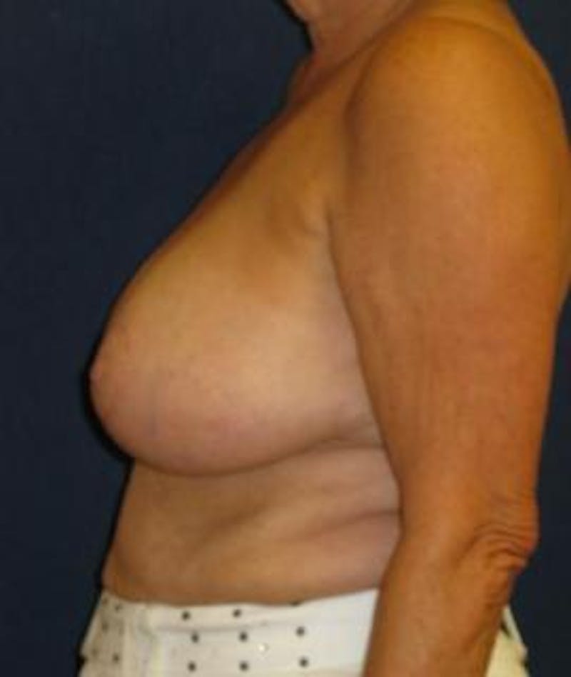 Breast Reduction Before & After Gallery - Patient 265841 - Image 4