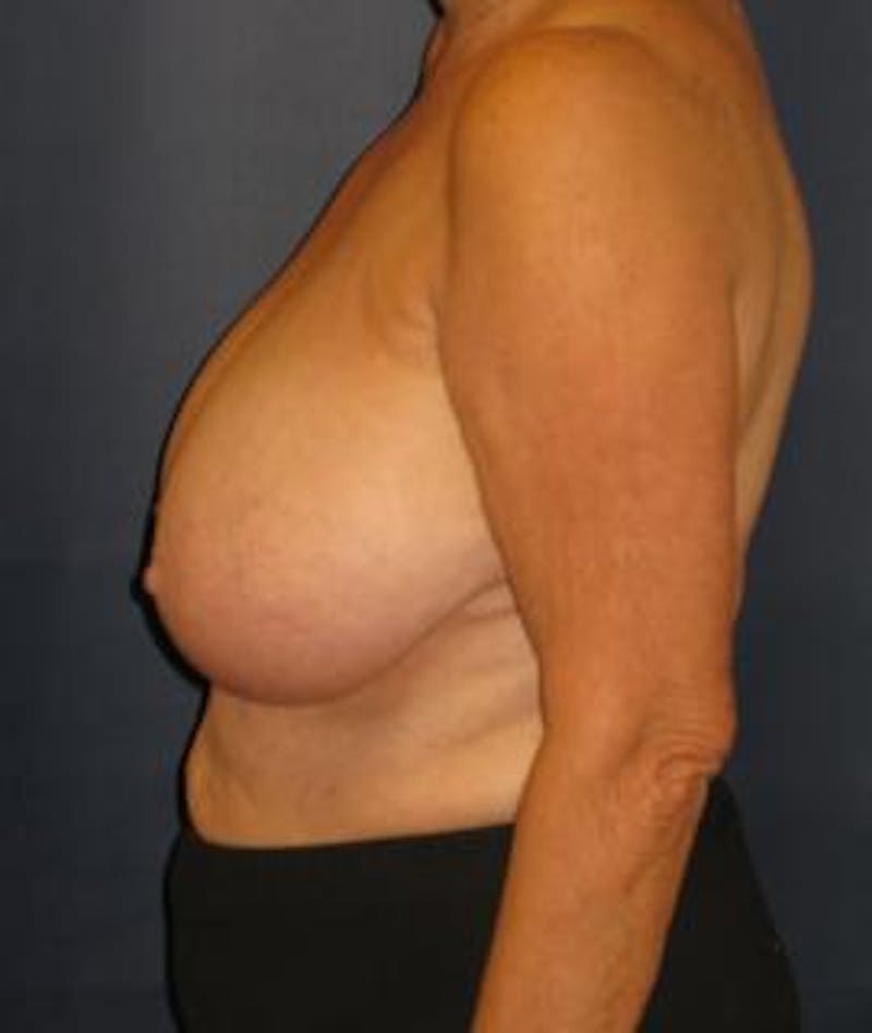 Breast Reduction Before & After Gallery - Patient 265841 - Image 3