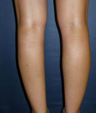 Calf Augmentation with Implants Before & After Gallery - Patient 825022 - Image 1