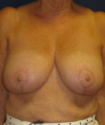 Breast Reduction Before & After Gallery - Patient 265841 - Image 2