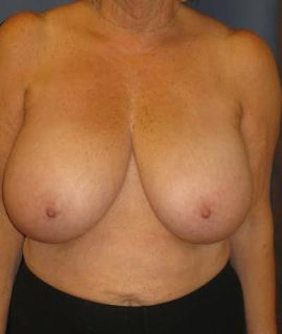 Breast Reduction Before & After Gallery - Patient 265841 - Image 1