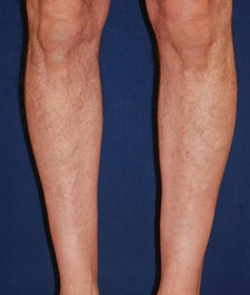 Calf Augmentation with Implants Before & After Gallery - Patient 795860 - Image 3