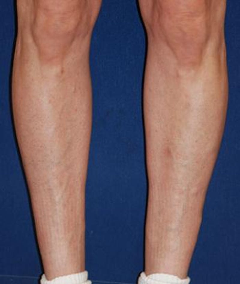 Calf Augmentation with Implants Before & After Gallery - Patient 795860 - Image 4
