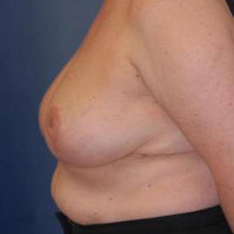 Breast Reduction Before & After Gallery - Patient 320261 - Image 4