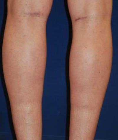 Calf Augmentation with Implants Before & After Gallery - Patient 795860 - Image 2