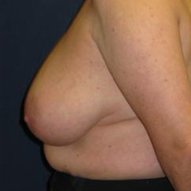 Breast Reduction Before & After Gallery - Patient 320261 - Image 3