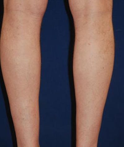 Calf Augmentation with Implants Before & After Gallery - Patient 795860 - Image 1