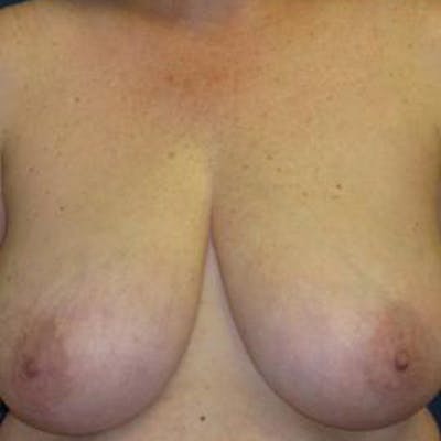 Breast Reduction Before & After Gallery - Patient 320261 - Image 1