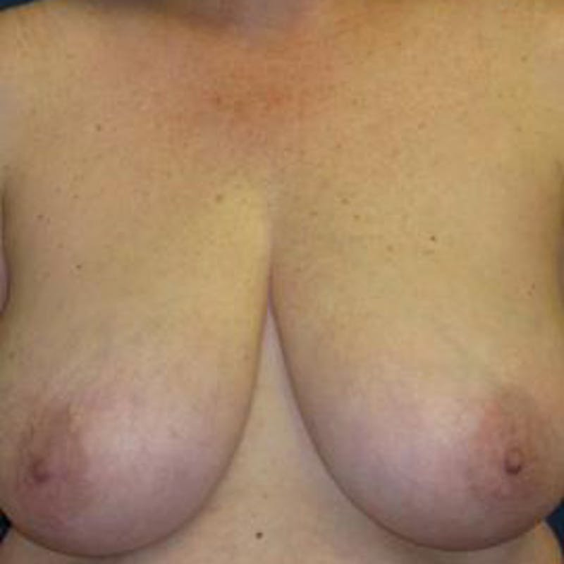 Breast Reduction Before & After Gallery - Patient 320261 - Image 1