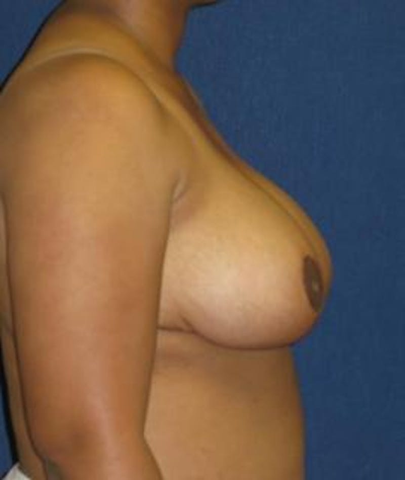 Breast Reduction Before & After Gallery - Patient 364213 - Image 4