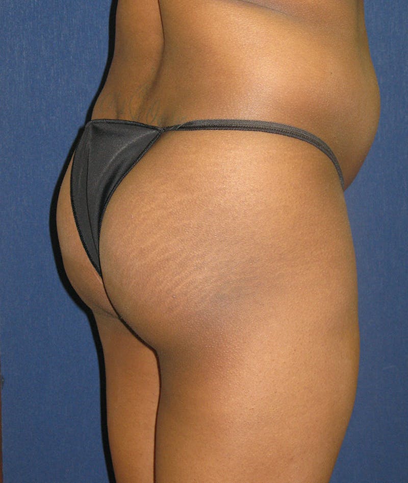 Buttock Lift Before & After Gallery - Patient 121582 - Image 7