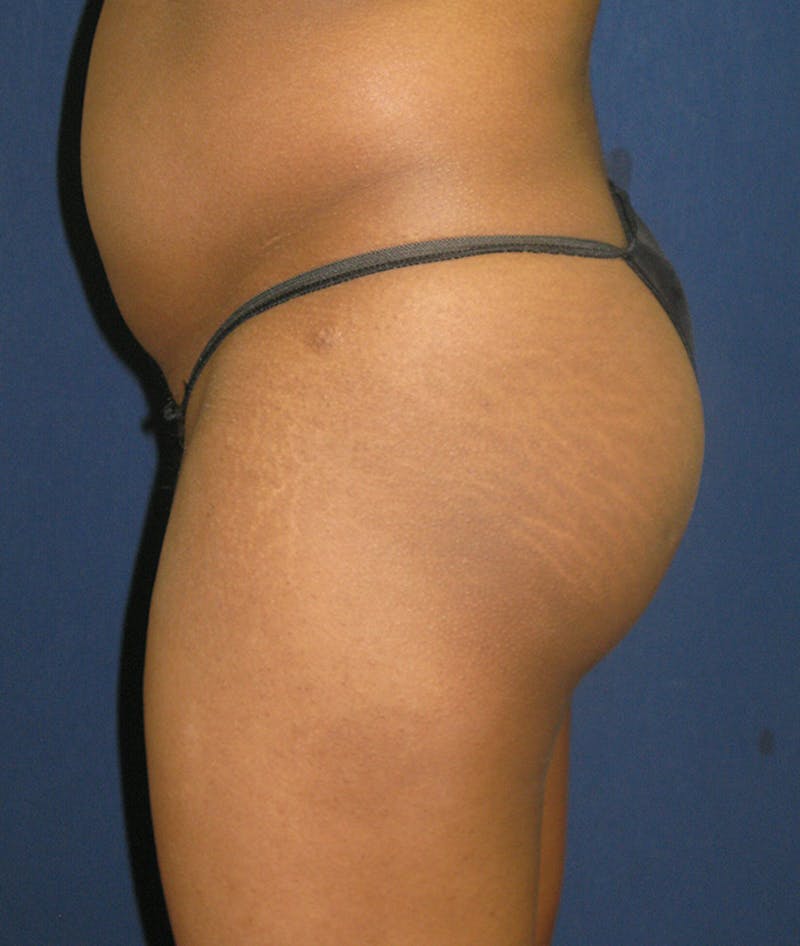 Buttock Lift Before & After Gallery - Patient 121582 - Image 5