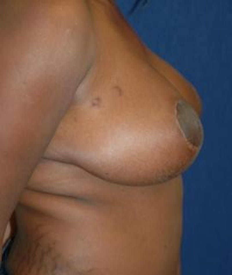 Breast Reduction Before & After Gallery - Patient 111456 - Image 4