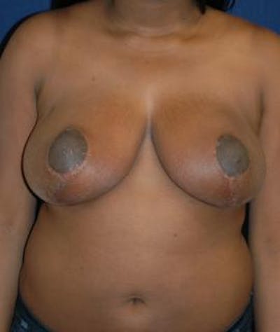 Breast Reduction Before & After Gallery - Patient 111456 - Image 2