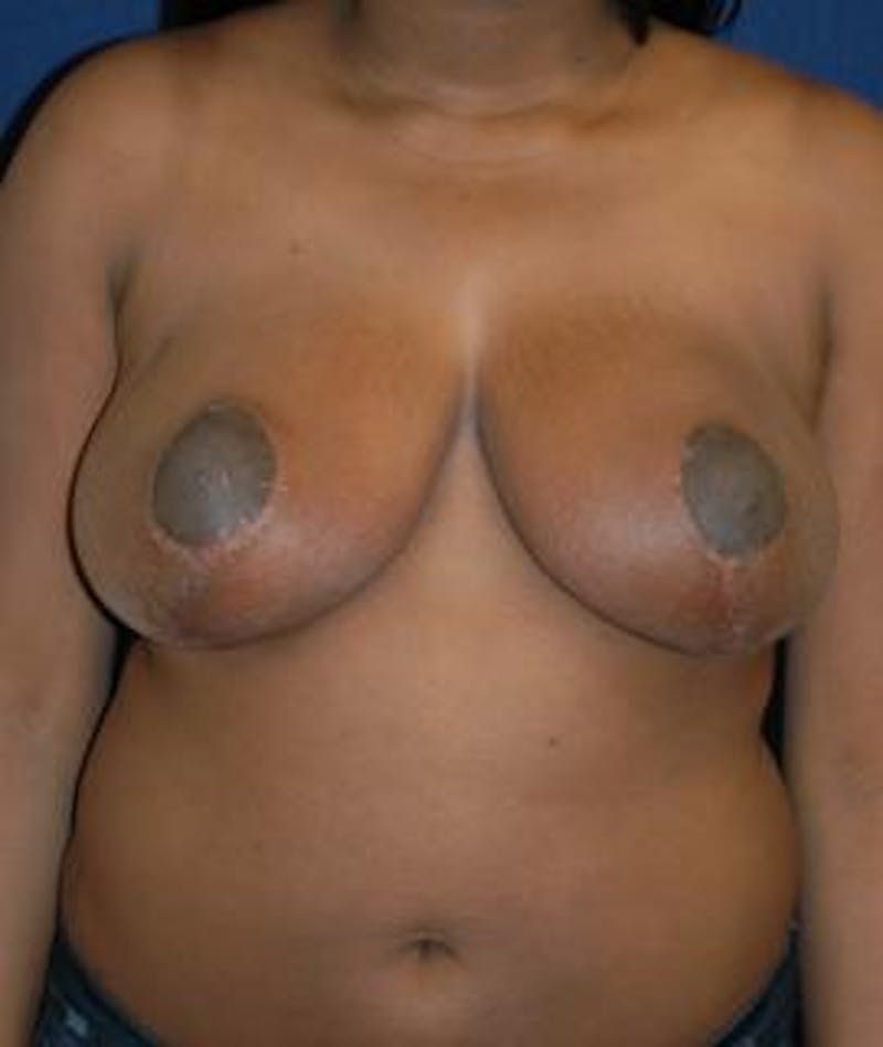 Breast Reduction Before & After Gallery - Patient 111456 - Image 2