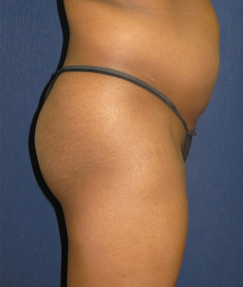 Buttock Lift Before & After Gallery - Patient 121582 - Image 3
