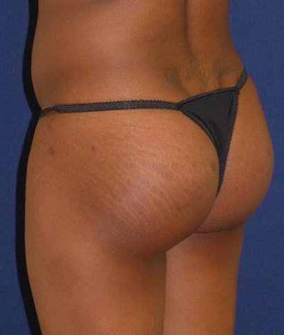 Buttock Lift Before & After Gallery - Patient 121582 - Image 2