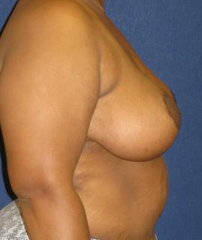 Breast Reduction Before & After Gallery - Patient 263602 - Image 4