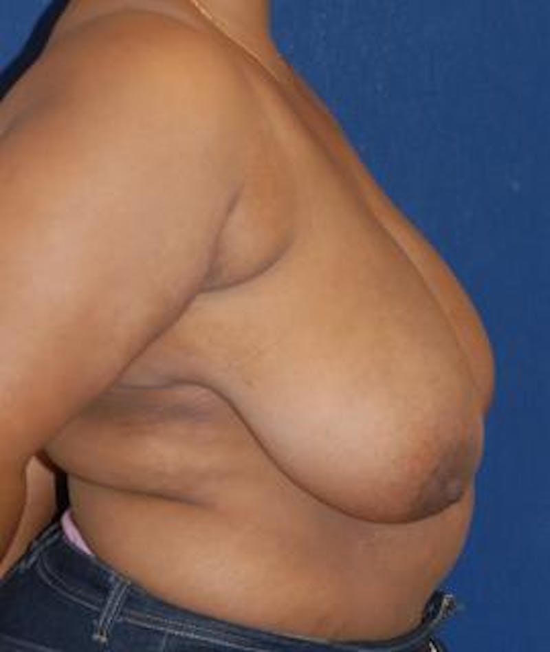 Breast Reduction Before & After Gallery - Patient 263602 - Image 3