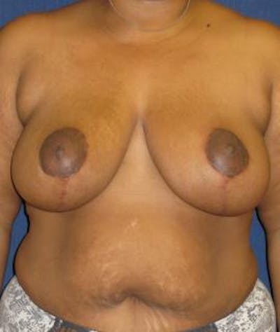 Breast Reduction Before & After Gallery - Patient 263602 - Image 2