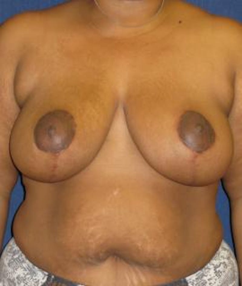 Breast Reduction Before & After Gallery - Patient 263602 - Image 2