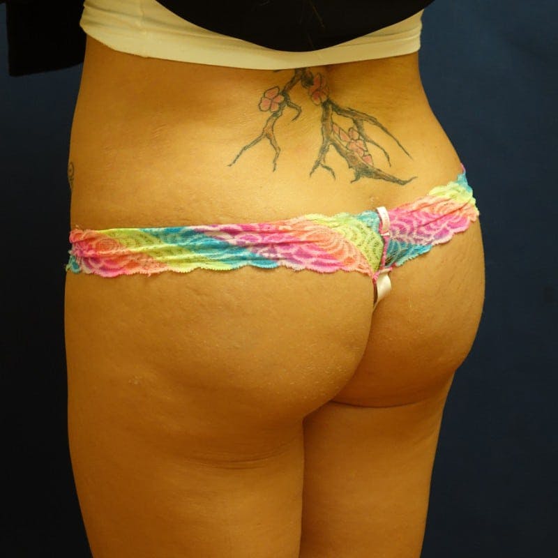 Buttock Lift Before & After Gallery - Patient 114132 - Image 4