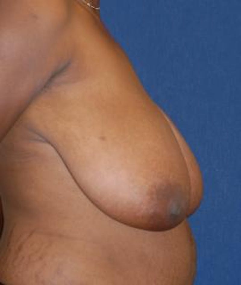 Breast Reduction Before & After Gallery - Patient 232979 - Image 4