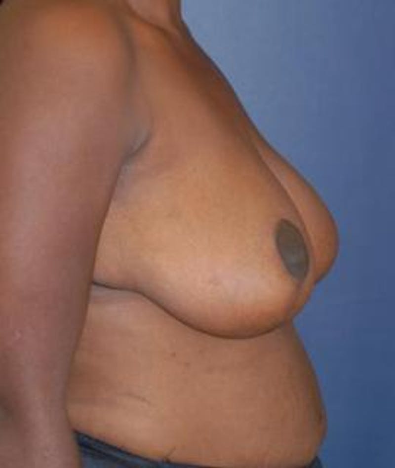 Breast Reduction Before & After Gallery - Patient 232979 - Image 3