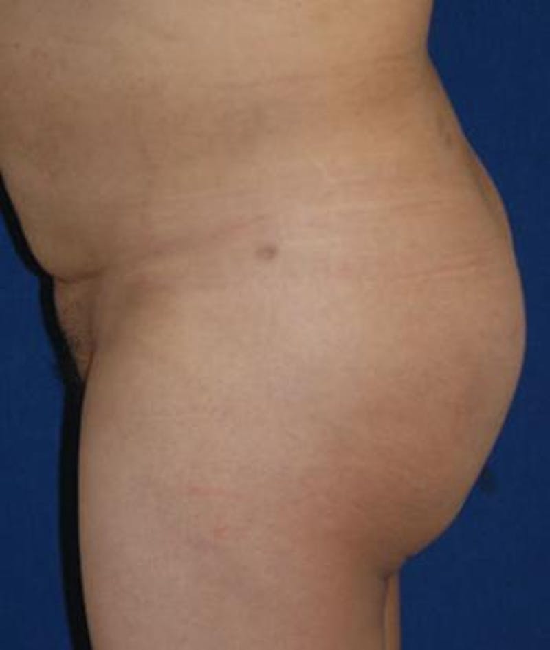 Buttock Lift Before & After Gallery - Patient 408435 - Image 4