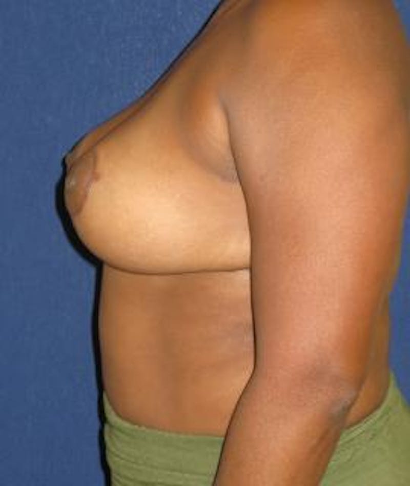 Breast Reduction Before & After Gallery - Patient 189206 - Image 6