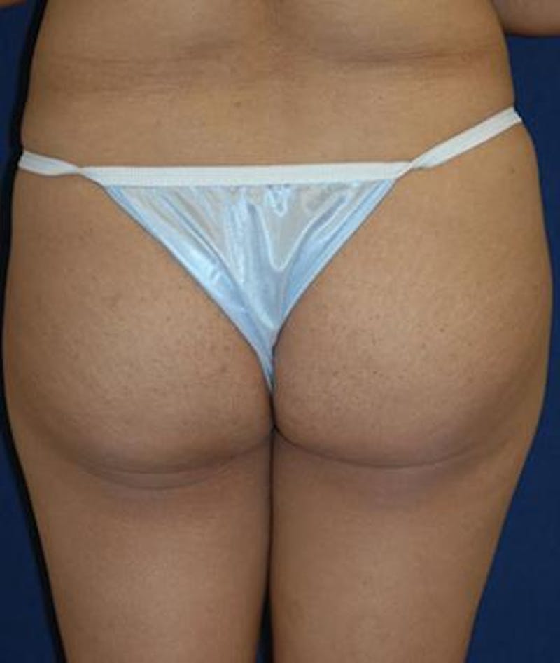 Buttock Lift Before & After Gallery - Patient 408435 - Image 1