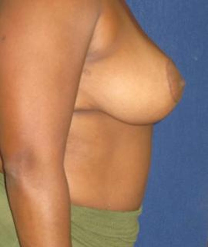 Breast Reduction Before & After Gallery - Patient 189206 - Image 4