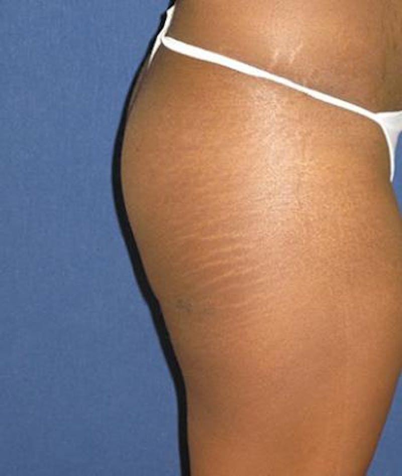 Buttock Lift Before & After Gallery - Patient 343192 - Image 4