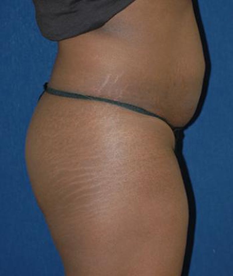 Buttock Lift Before & After Gallery - Patient 343192 - Image 3