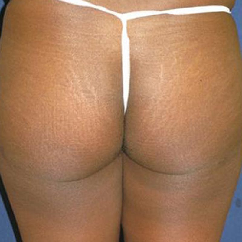 Buttock Lift Before & After Gallery - Patient 343192 - Image 2