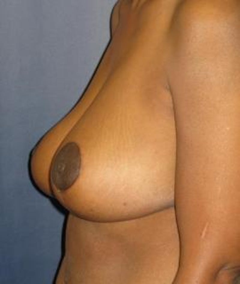 Breast Reduction Before & After Gallery - Patient 305987 - Image 4