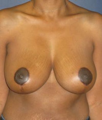 Breast Reduction Before & After Gallery - Patient 305987 - Image 2