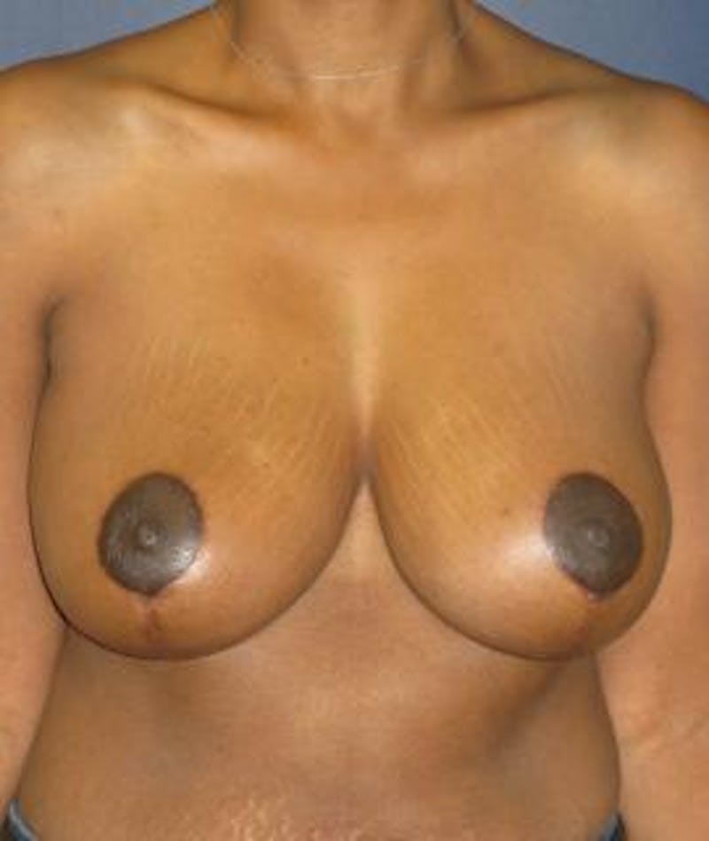 Breast Reduction Before & After Gallery - Patient 305987 - Image 2