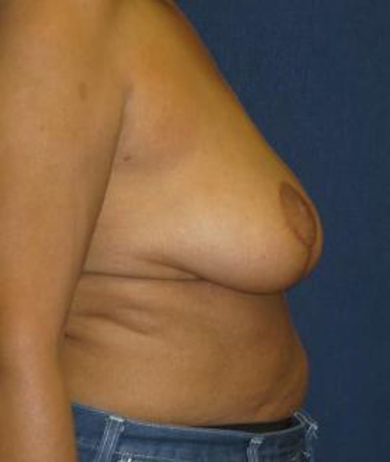 Breast Reduction Before & After Gallery - Patient 502855 - Image 4
