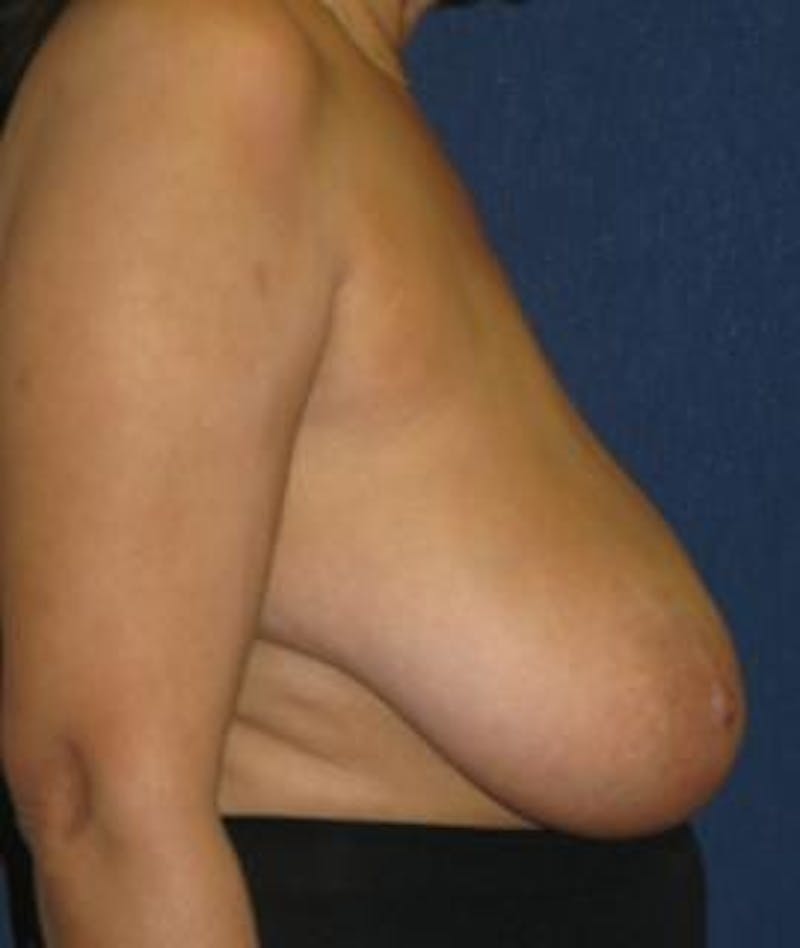 Breast Reduction Before & After Gallery - Patient 502855 - Image 3