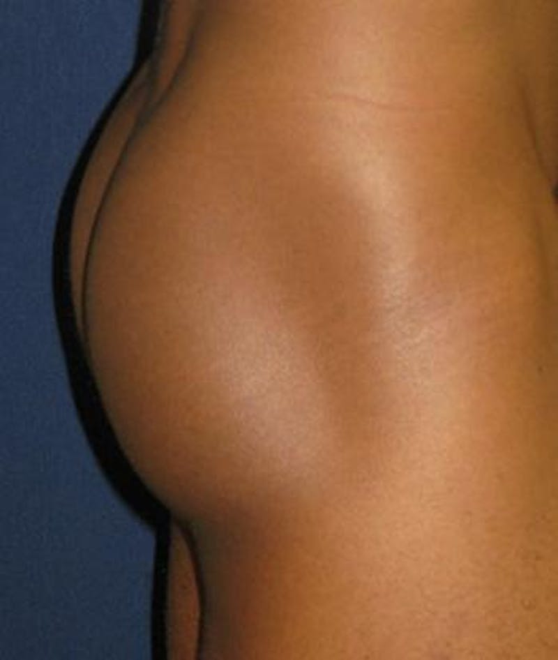 Buttock Lift Before & After Gallery - Patient 370256 - Image 4