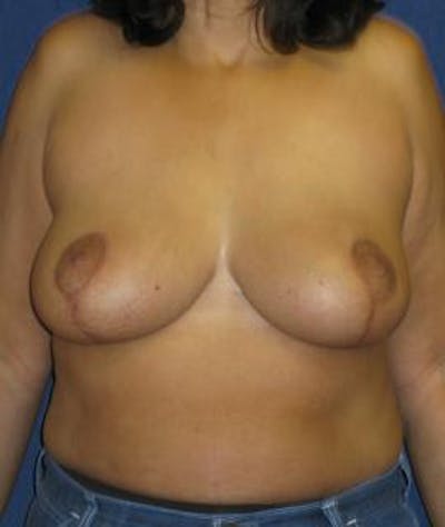Breast Reduction Before & After Gallery - Patient 502855 - Image 2