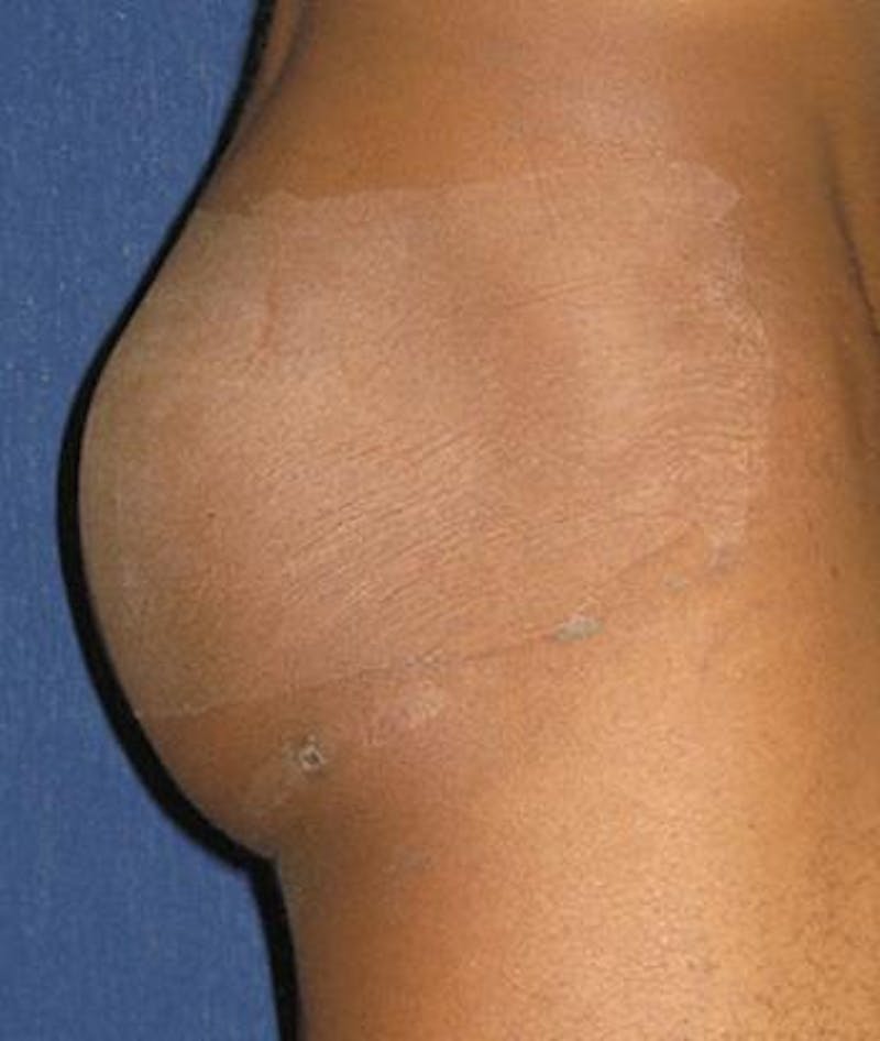 Buttock Lift Before & After Gallery - Patient 370256 - Image 3