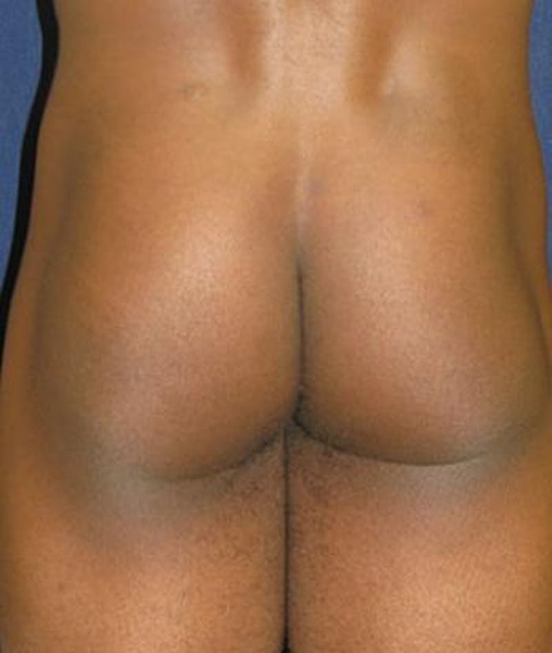Buttock Lift Before & After Gallery - Patient 370256 - Image 2