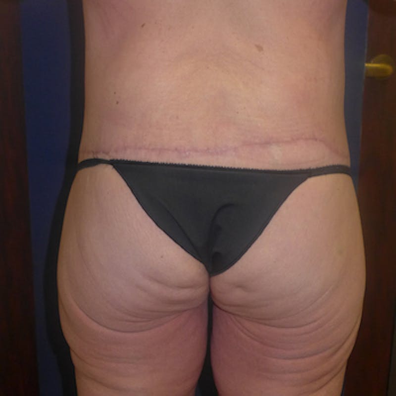 Body Lift Before & After Gallery - Patient 332668 - Image 4