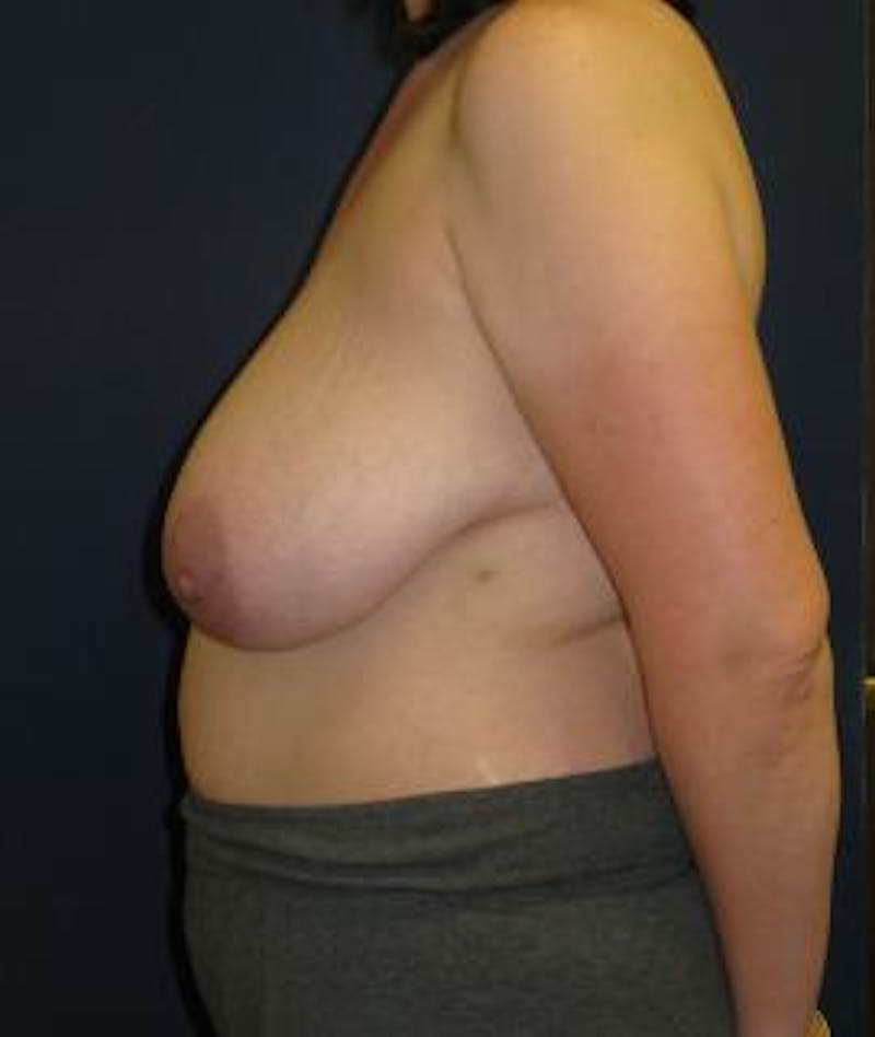 Breast Reduction Before & After Gallery - Patient 284136 - Image 3