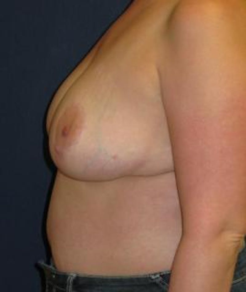 Breast Reduction Before & After Gallery - Patient 284136 - Image 4