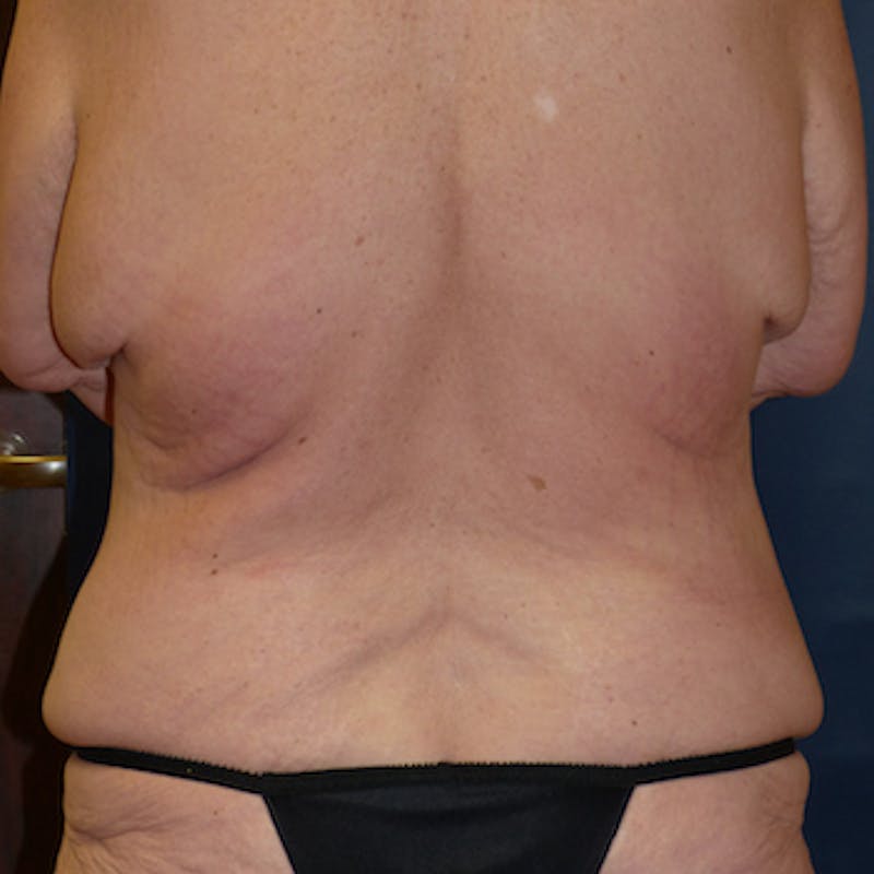 Body Lift Before & After Gallery - Patient 332668 - Image 3